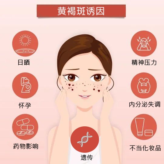 causes of melasma_1697713156_1720440509.jpg