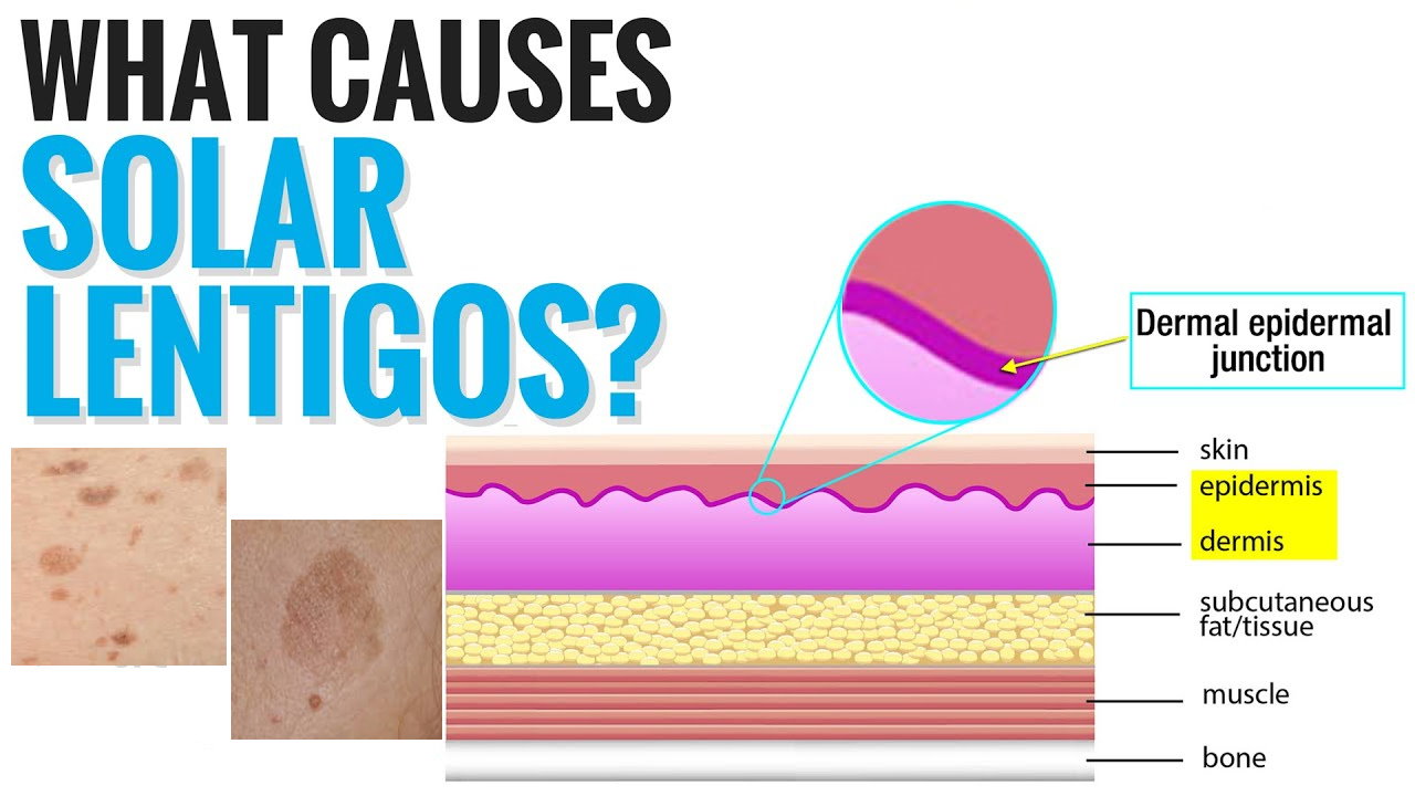 孚美达“氟轻松氢醌维A酸乳膏”能用于老年斑治疗吗？