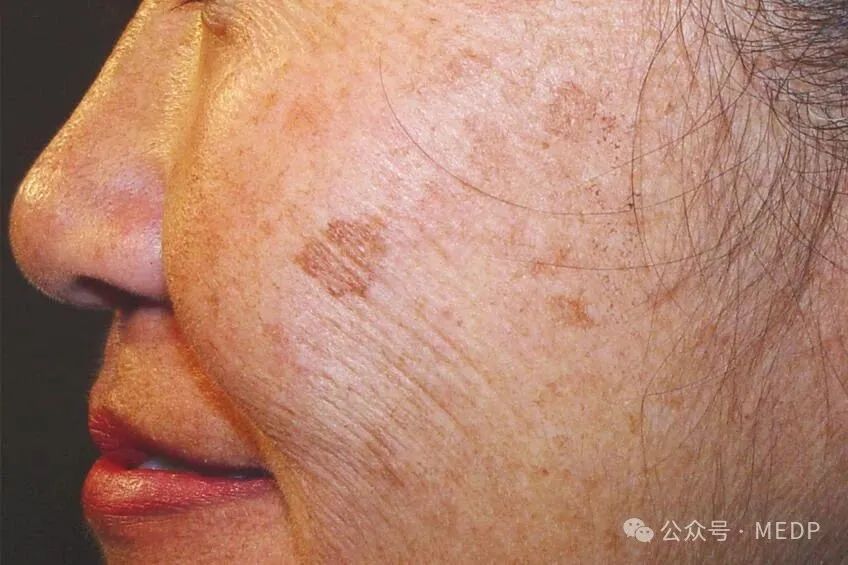 老年斑、晒斑、日光性雀斑是一回事吗？